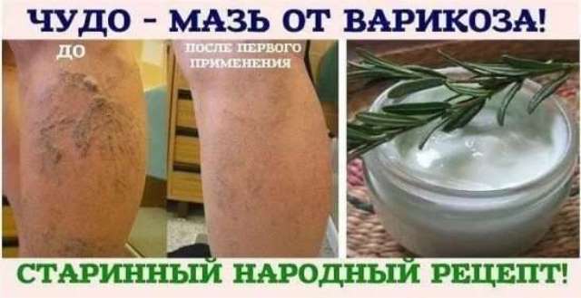 Лучшие народные рецепты от варикоза