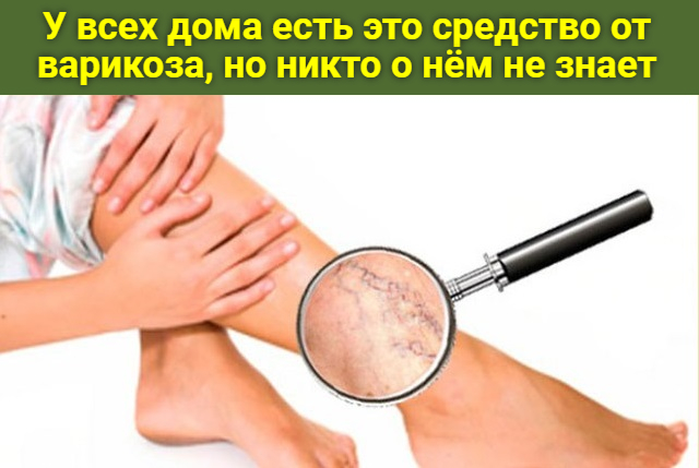 У всех дома есть это средство от варикоза, но никто о нем не знает
