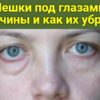 Мешки под глазами: причины и как их убрать