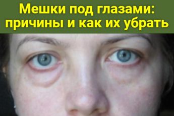 Мешки под глазами: причины и как их убрать
