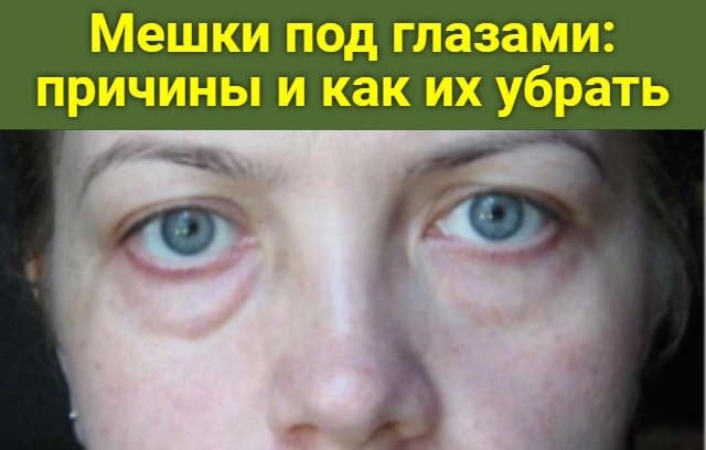Мешки под глазами: причины и как их убрать