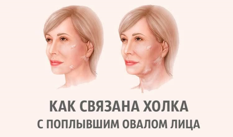 Поплывший овал лица. Как связана холка с поплывшим овалом лица