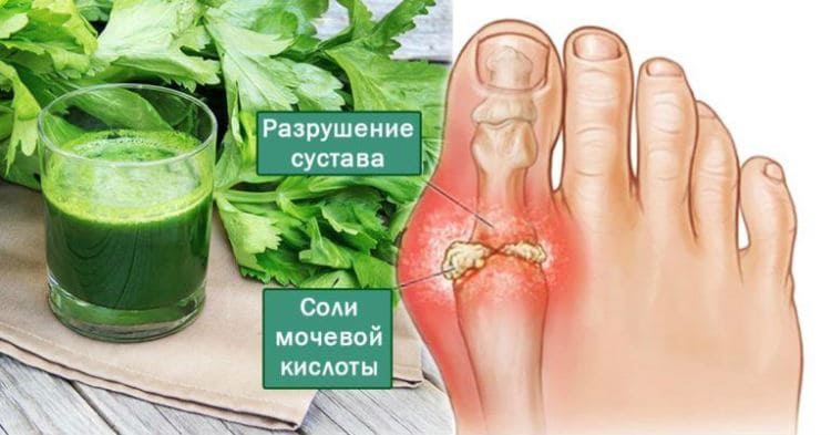 Удали мочевую кислоту и избавься от боли в суставах!