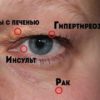 8 сигналов, при помощи которых глаза предупреждают о проблемах со здоровьем! Обрати внимание!