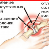 Как избежать подагры и опухолей? Удали мочевую кислоту из суставов